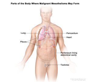 Read more about the article Living With Mesothelioma: Coping Strategies and Support