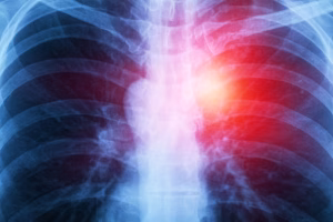 Read more about the article Mesothelioma Self Care: Essential Tips for Managing Your Health