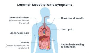 Read more about the article Pleural Mesothelioma: Symptoms, Diagnosis, and Treatment Options